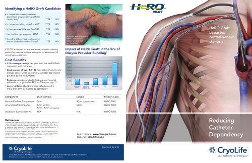 HeRO Graft bypasses central venous stenosis