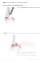 TALUS OSTEOTOMY-9
