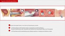Fraktionierter CO2-Laser-13