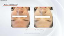 IPL mit Filtern-11