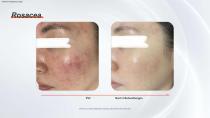 IPL mit Filtern-12