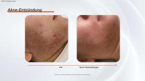 IPL mit Filtern-15