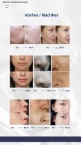 Tragbare Hydrafacial-Gesichtsbehandlung-7