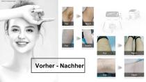 Tragbarer Diodenlaser-18