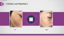 tragbarer Picolaser-15