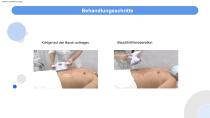 V-shaping-15