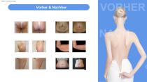 V-shaping-16
