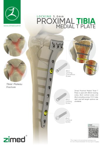 proximal-medial-tibial-Medial-T-plate