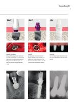 SKY Implantatsystem – DNA-9