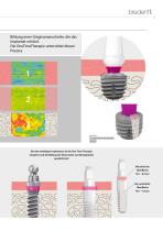 SKY Implantatsystem – DNA – Systemvorstellung - 11