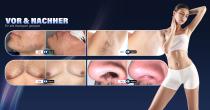 Perfectlaser Z890SH 4-Wellenlängen-Diodenlaser-Haarentfernung - 15